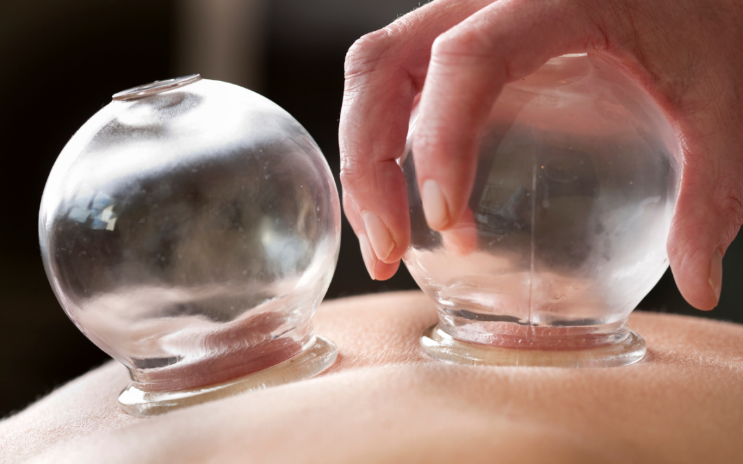 What Is Cupping Therapy (And Why Should I Try It)?